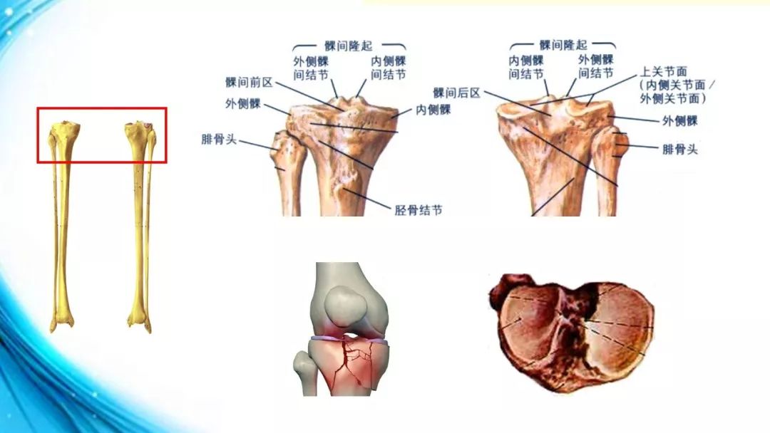 密质少,所以为膝关节内骨折的好发部位,临床常见于胫骨平台骨折