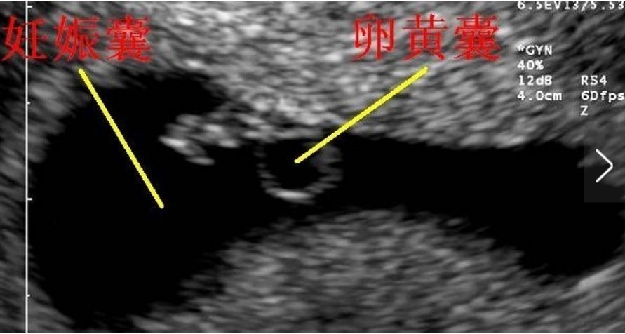 早孕期超声小知识