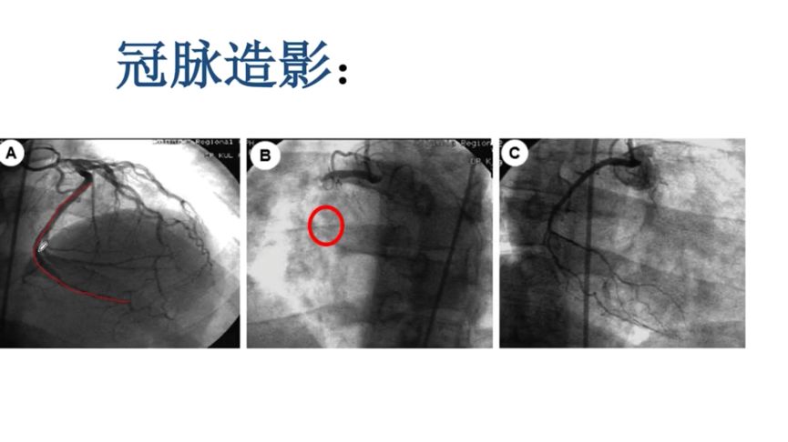 冠脉造影左冠系统通畅(a图,右冠状动脉近端转折时闭塞(b,c图为右