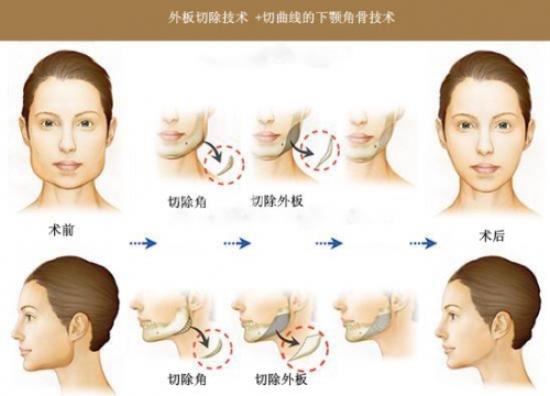 改脸型手术有几种方式?手术切口在哪里?