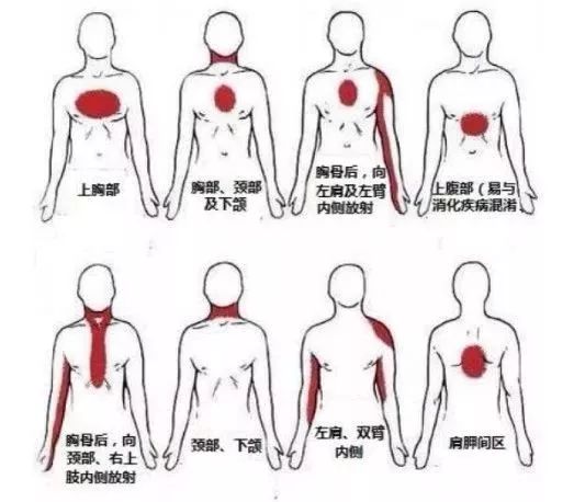 这里要强调一下,放射痛的范围很广,包括胃,下巴,肩膀,颈部,后背,左臂