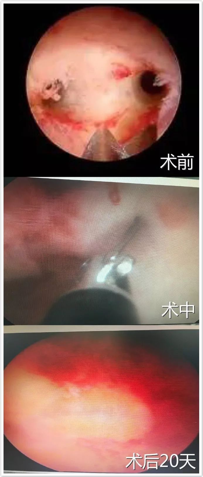 子宮縱膈的剋星,法國heos宮腔鏡冷刀技術