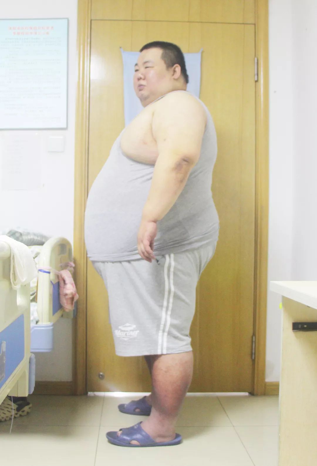 新闻正前方报道400多斤巨胖生活艰难急求减肥良方爱心医院伸出援手助
