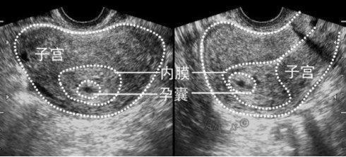 另外,看孕囊形狀,像茄子或者長條狀的,大概率是男寶;像圓圓的,大概率