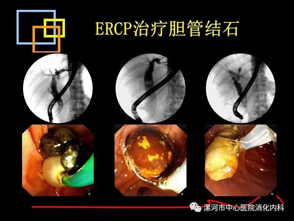 科普ercp治療膽總管結石的法寶