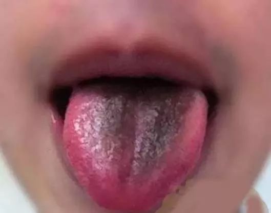 婴儿舌苔发黑图片图片