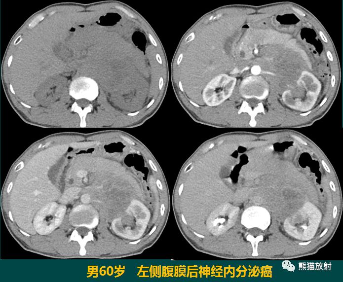 少见部位神经内分泌癌丨ct与mri表现