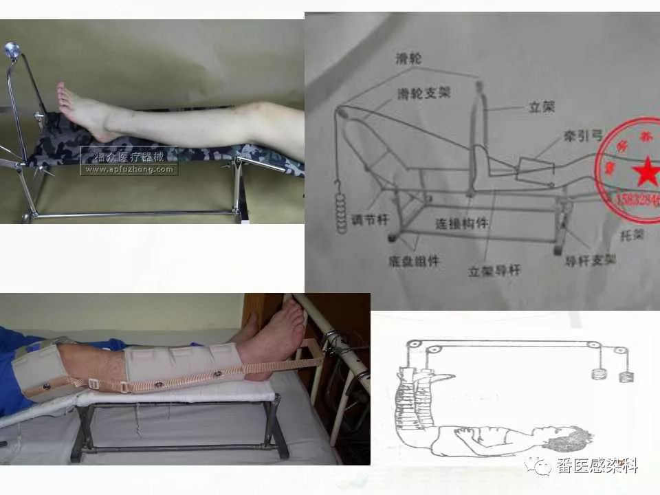 牽引病人的護理