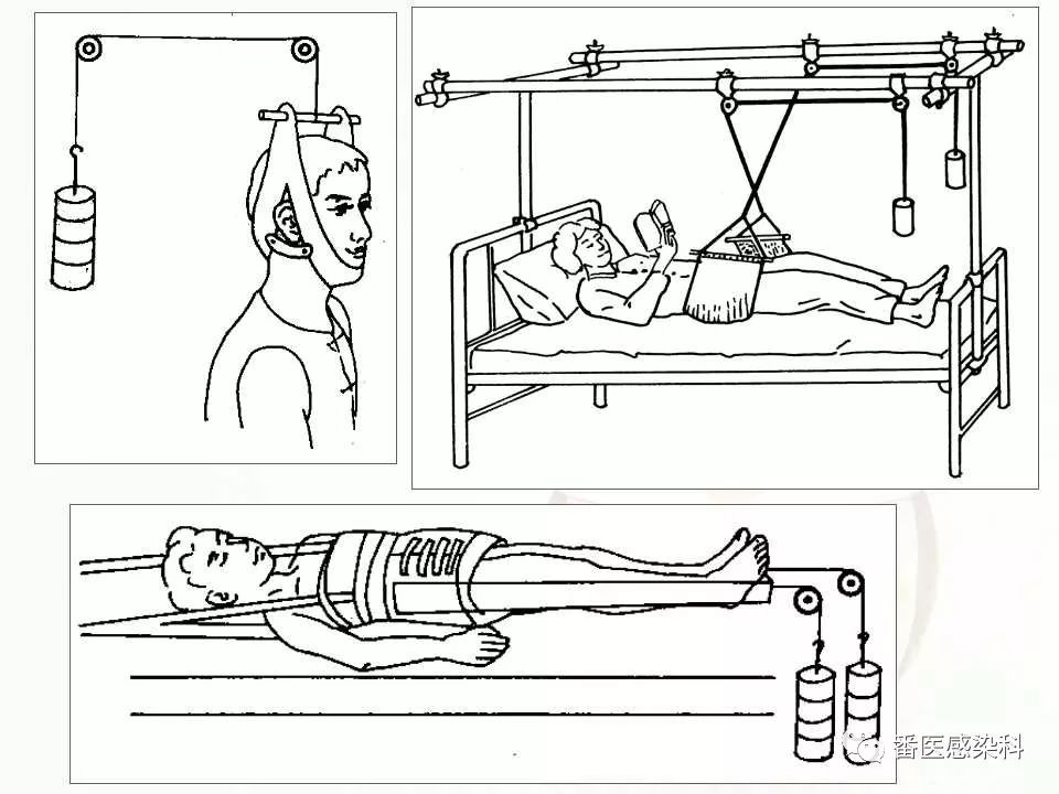 腰椎牵引示意图图片