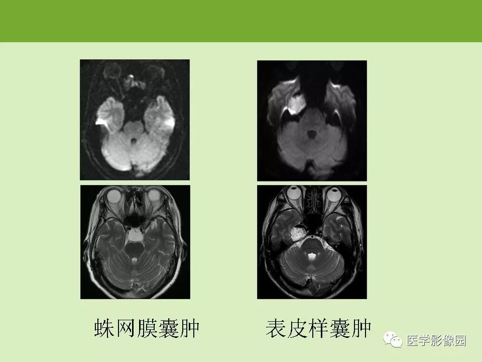 鞍区肿瘤的影像诊断与鉴别诊断影像天地