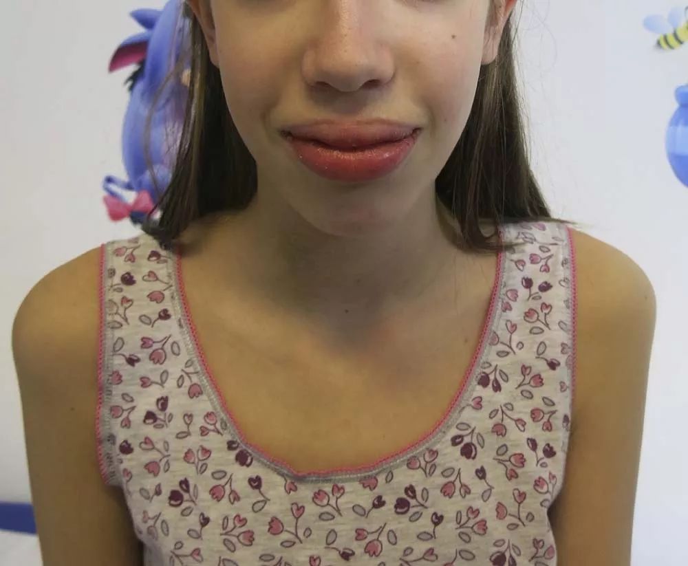 有奖病例竞猜第151期丨一名青春期发育延迟伴唇部凹凸不平的女孩