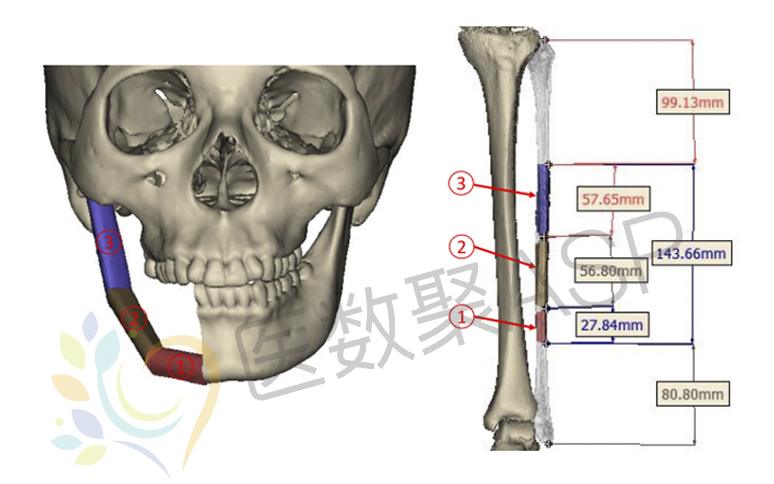 ct三维重建在下颌骨重建临床中的意义