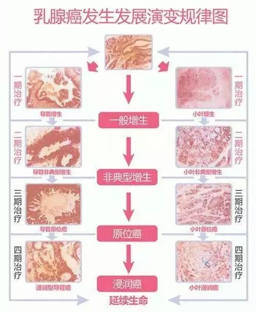 乳腺疾病的发展过程图图片