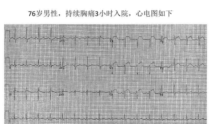 v1-v5导联st段抬高,按照诊断书或内科书标准应该是广泛前壁的心肌梗死