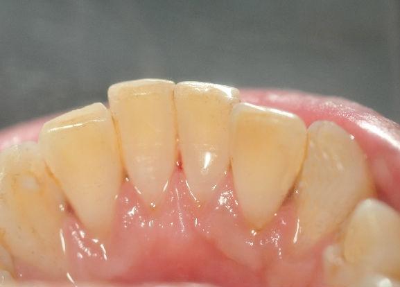 初步判断牙周病程度,一是超声波洗牙清除龈上牙结石,二是测量牙周袋