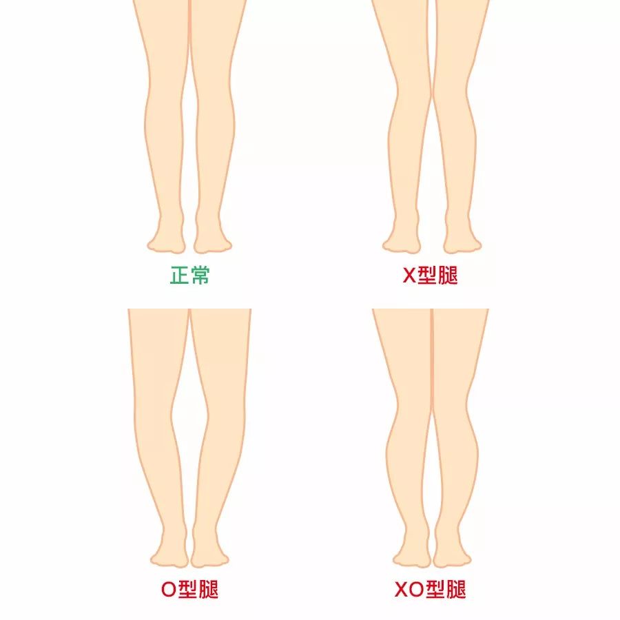 x型腿和o型腿 图示图片