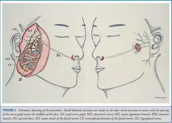舌下神經與面神經頸面支吻合)並且聯合跨面部神經移植