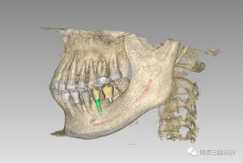 3d打印手術導板在製作前通過專用軟件對cbct的dicom原始數據導入,可在