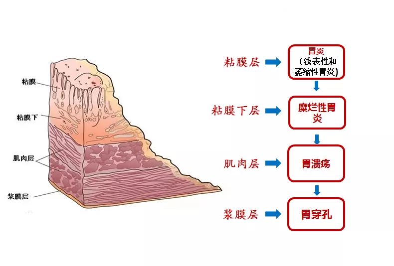 胃癌的演变过程图图片