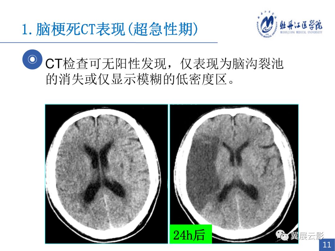 脑梗死影像诊断