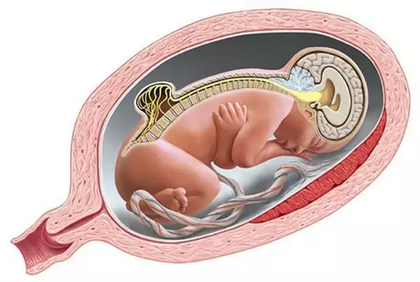 新生儿脊柱裂小凹图片图片