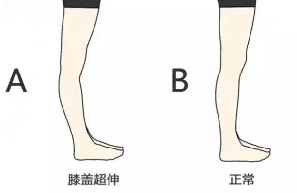 站直膝盖往后弯图片图片