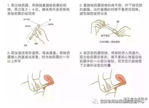 黄体酮凝胶使用示意图图片