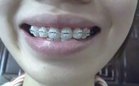 齿性龅牙 牙套图片