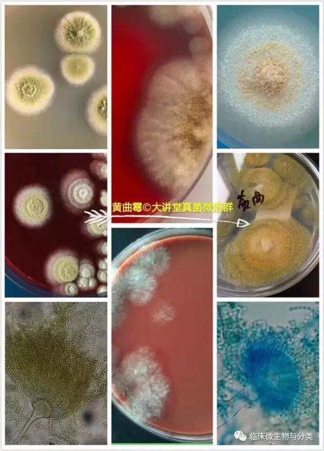 马尔尼菲蓝状菌患者图片