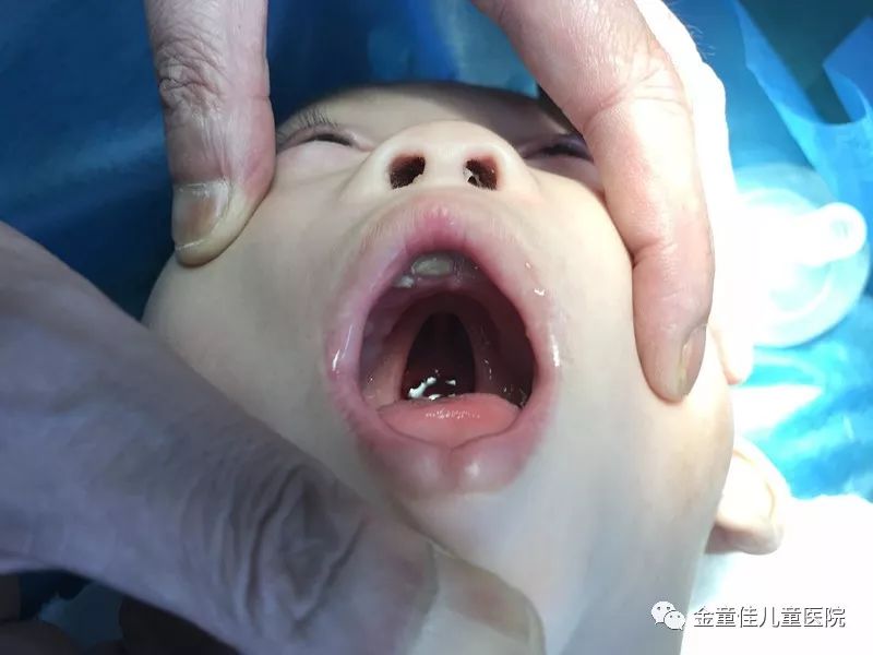 宝宝喉咙腭裂图图片