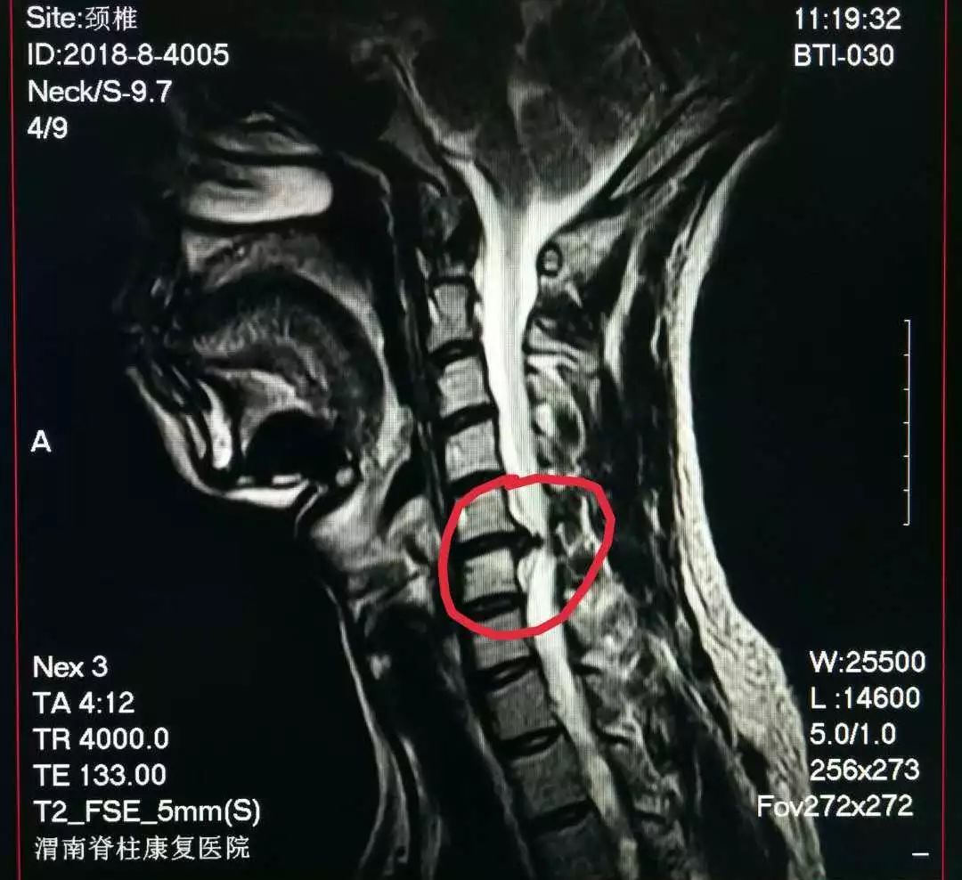 颈椎突出是什么样子的图片