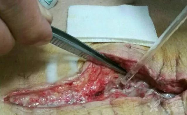 剖宫产术后伤口裂开该这样一步步处理