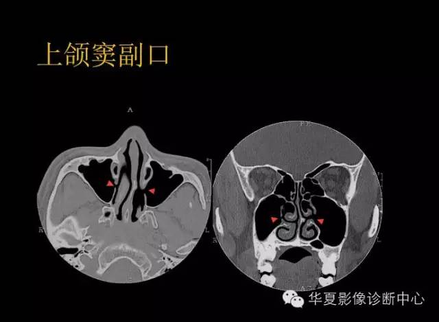 副鼻窦断层解剖图片