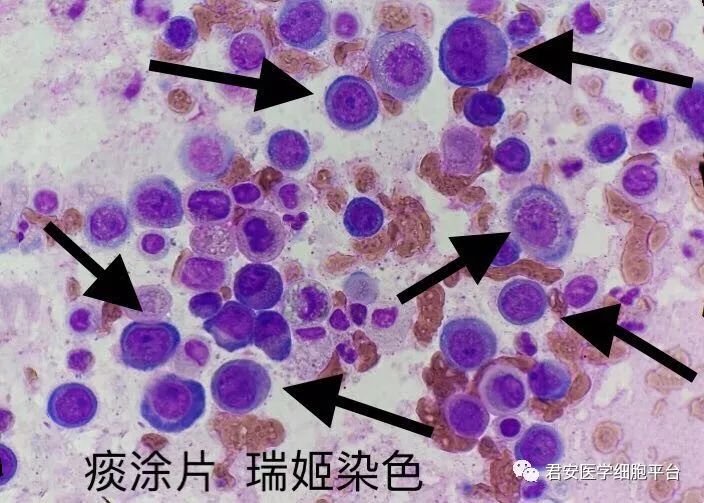 马尔尼菲篮状菌主要位于巨噬细胞内,菌体大小 2～8μm,有类圆形,长