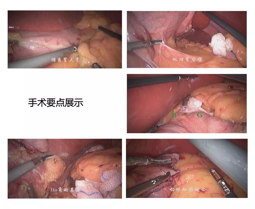 巴氏腺囊肿造口术步骤图片