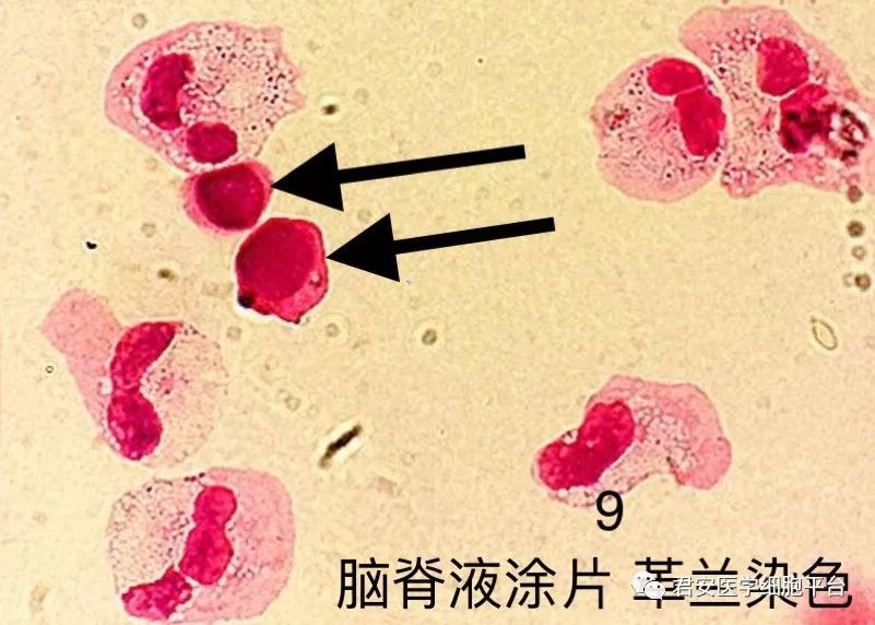 马尔尼菲篮状菌主要位于巨噬细胞内,菌体大小 2～8μm,有类圆形,长