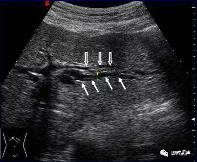 肝内胆管扩张超声图片