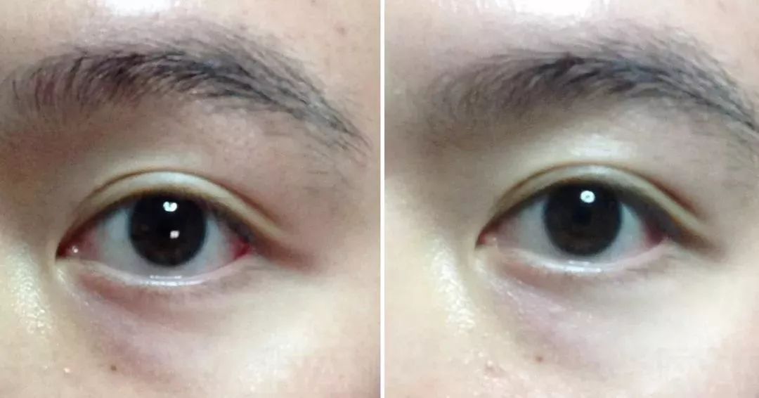 这些是忠粉发来的使用对比图,可以看到黑眼圈明显淡化了,且眼周肌肤更