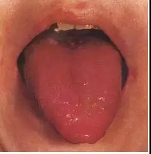 舌尖上的秘密哪些疾病征兆能从舌头上看出来