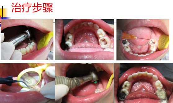 儿童牙齿常检查乳牙龋病要治疗