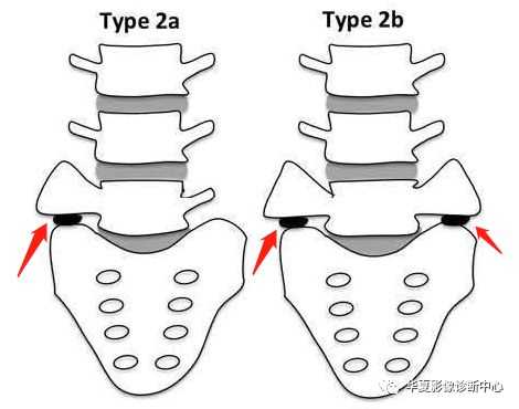 读书笔记腰骶部移行椎castellvi分型