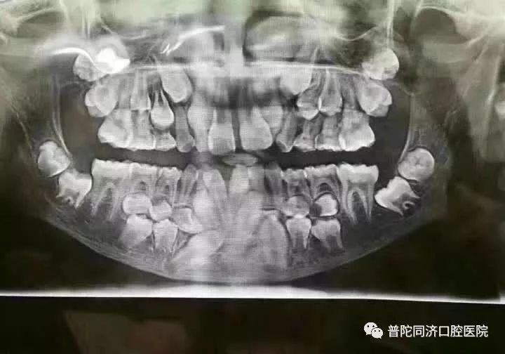 孩子爸爸说12岁了只换牙4颗,拍过片子后发现孩子牙齿多生,错乱