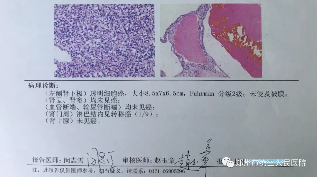 常保東在完善檢查結果後診斷孫先生為腎癌,建議通過手術治療.