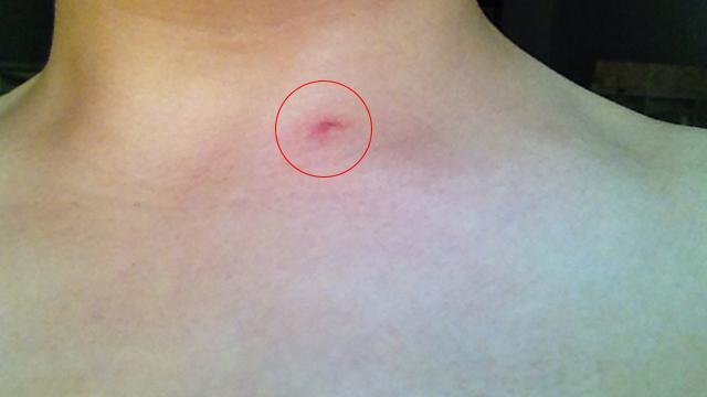 肝病蜘蛛痣图片 胸前图片