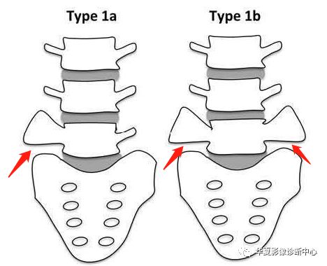读书笔记腰骶部移行椎castellvi分型