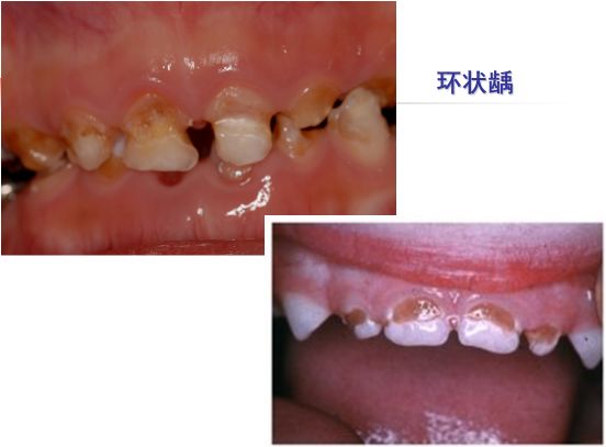 环形龋图片