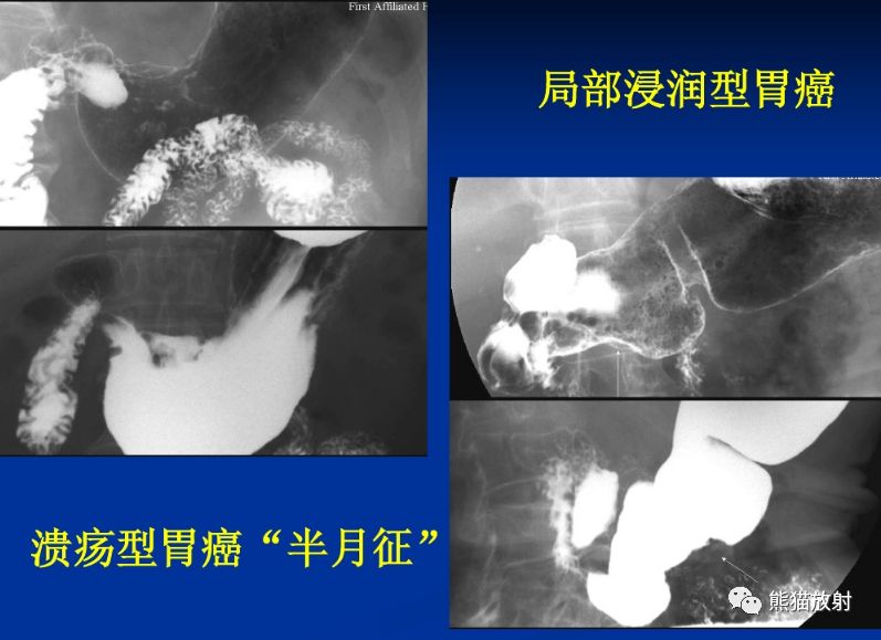 胃癌半月综合征图片