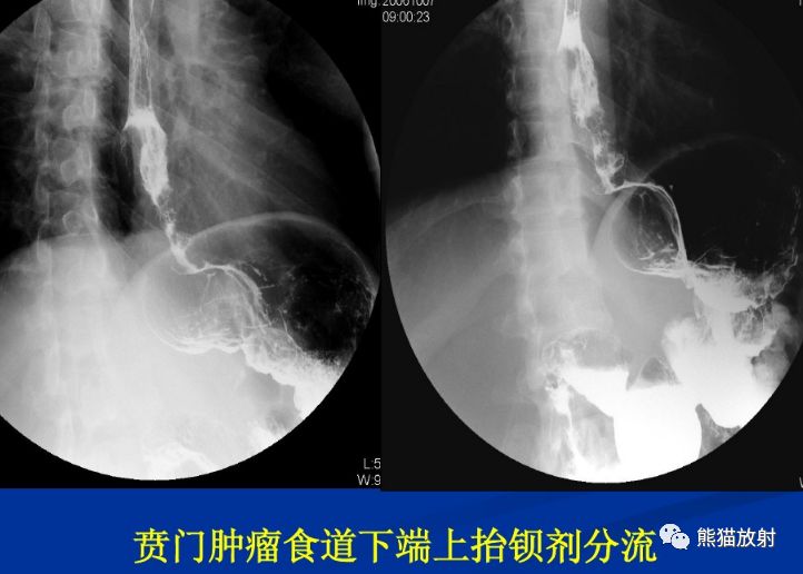 x线诊断要点丨胃肿瘤的那些概念和征象