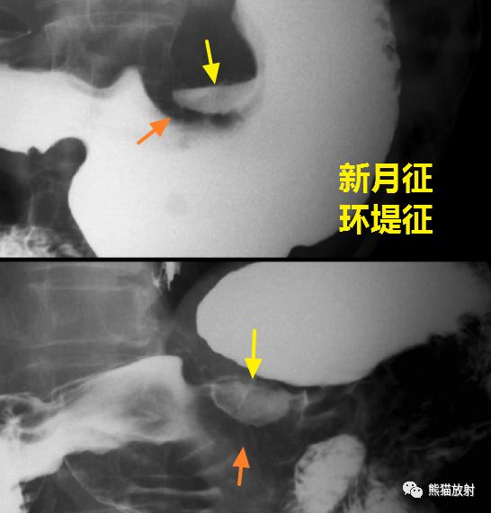 x线诊断要点丨胃肿瘤的那些概念和征象