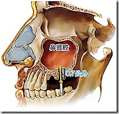 鼻窦炎上身竟是不当植牙打穿上颌窦——再谈不是所有口腔医师都可以